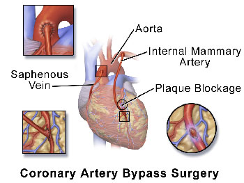Bypass surgery