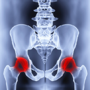 Coxarthrosis of the Hip Joint