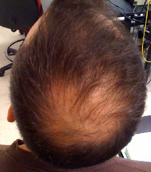 Alopecia treatment 